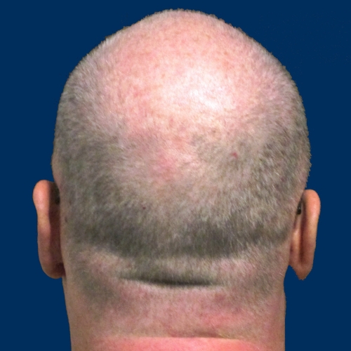 Hair cloning: A new hope for reversing male pattern baldness