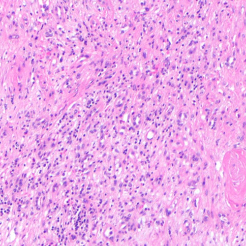 Targeting WSTF: A new strategy to block chronic inflammation