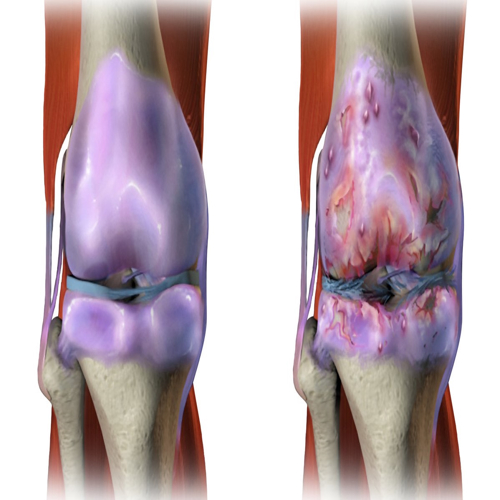 New molecule could help ageing joints repair damaged cartilage