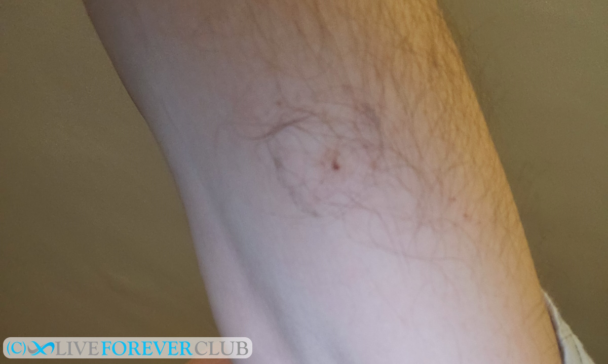 freestyle libre CGM removed
