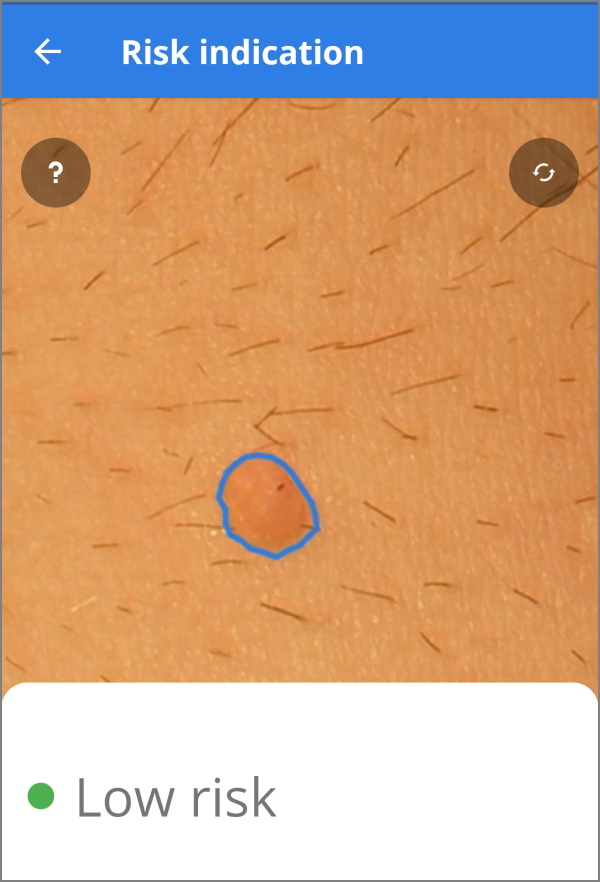 SkinVision app - spot on stomach